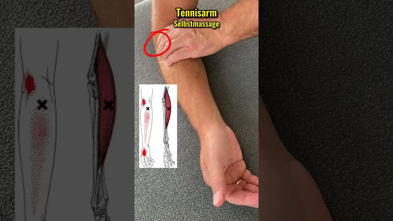 Tennisarm Selbstmassage