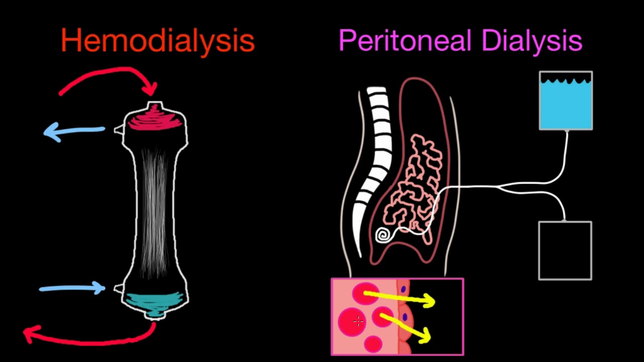 Basics of Dialysis and Modalities