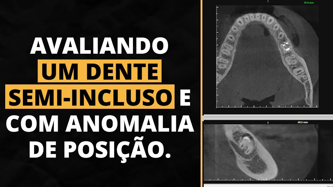 AVALIANDO UM DENTE SEMI-INCLUSO E COM ANOMALIA DE POSIÇÃO