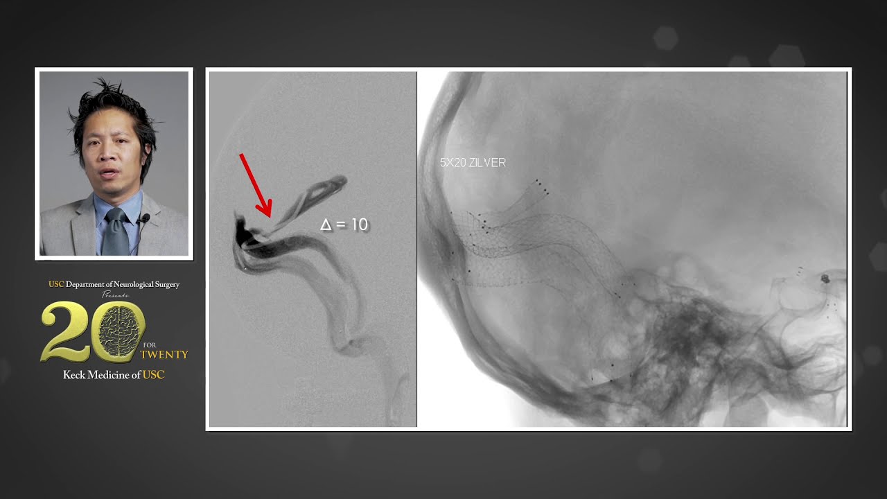 Venous Compression Syndromes: From Diagnosis to Treatment