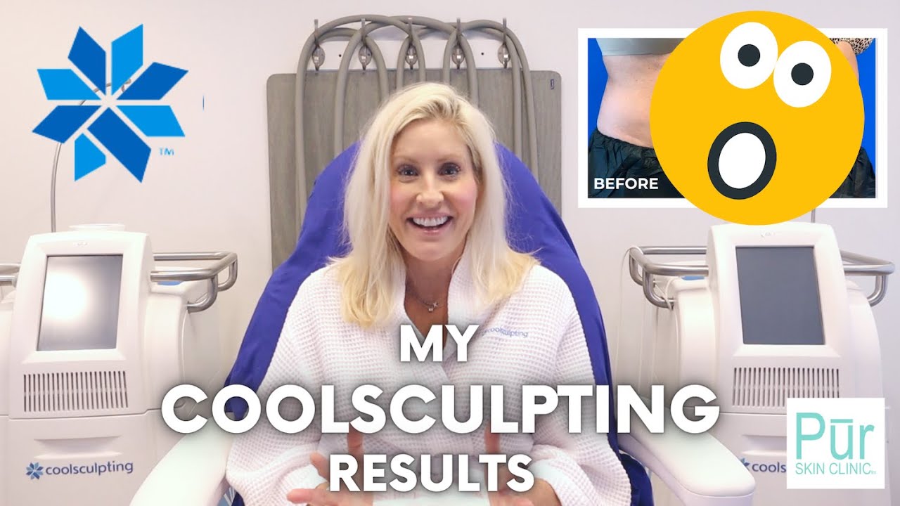 My COOLSCULPTING Results | CoolSculpting Before & After | Does It Work? | Pūr Skin Clinic