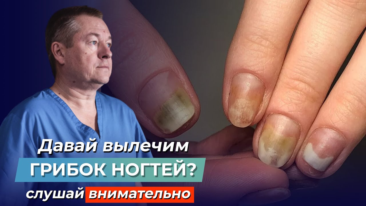 ШОКИРУЮЩАЯ ПРАВДА ПРО ГРИБОК НОГТЕЙ! Как вылечить ОНИХОМИКОЗ самостоятельно?