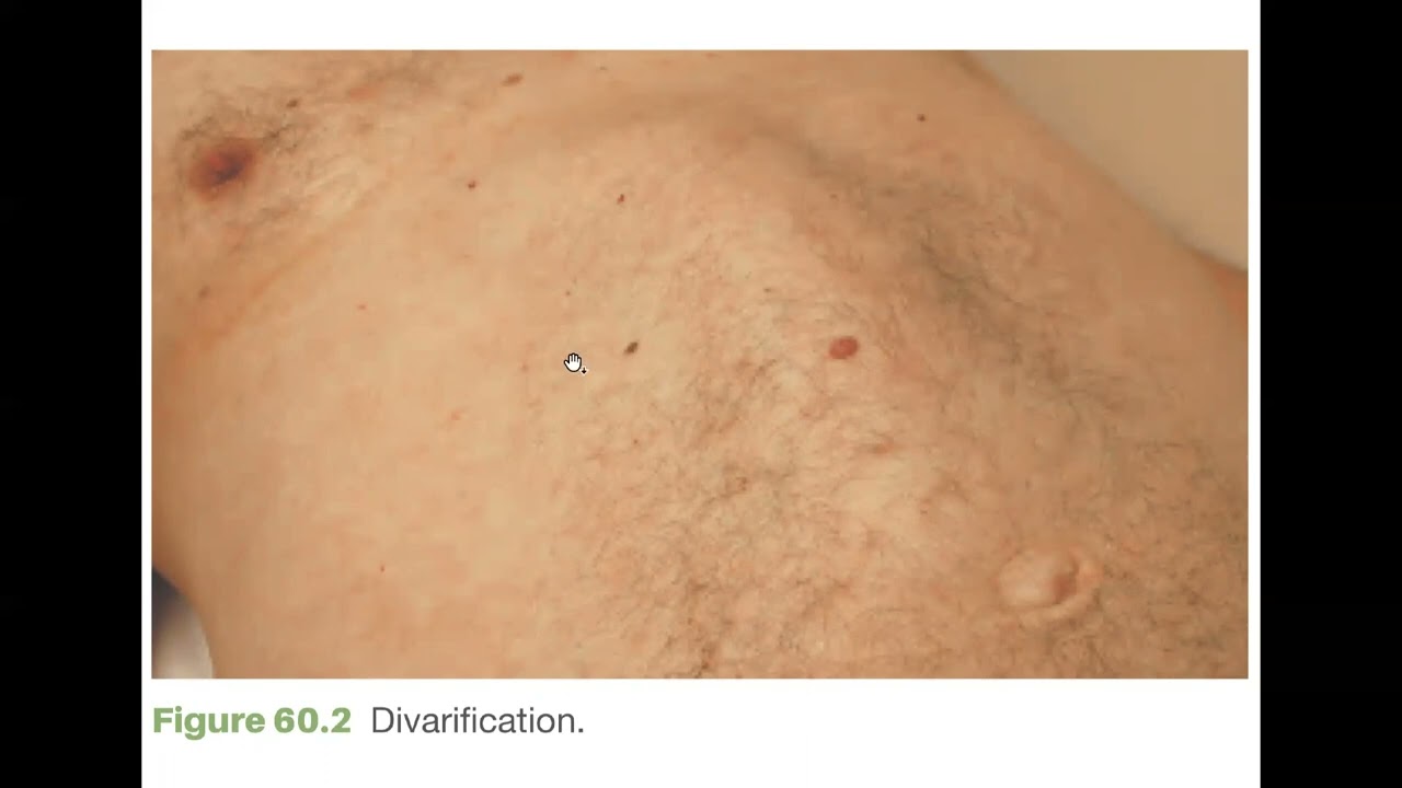 Introduction (Abdominal wall, hernia)        MDF Courses