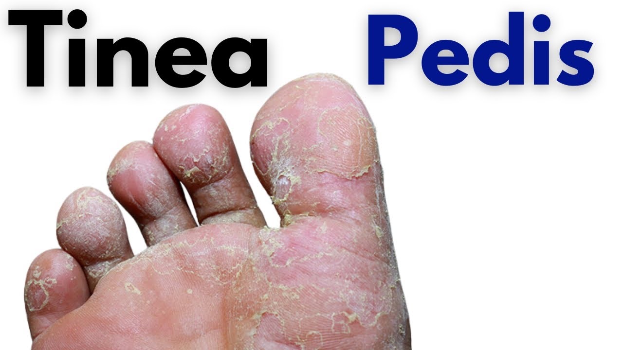 Tinea pedis symptoms and treatment | Toe fungus infection | athletes foot
