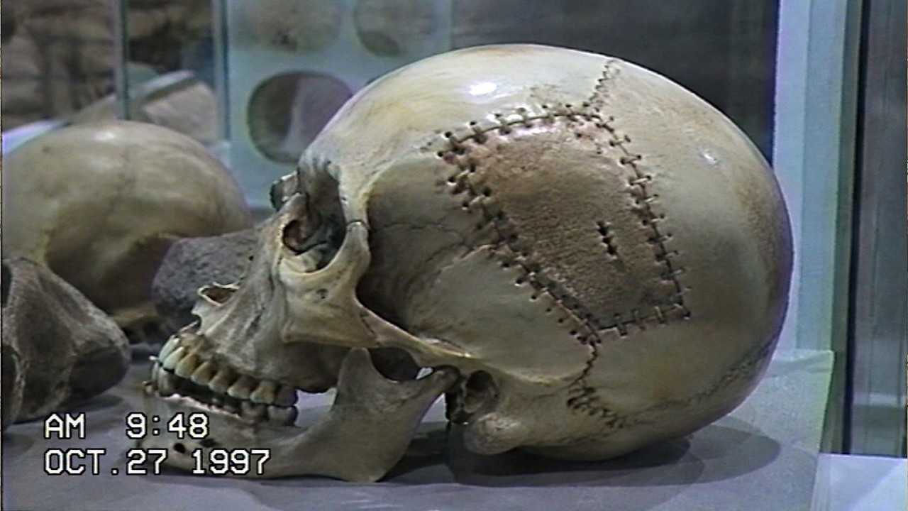 Evidence Of Advanced Surgery Found On Ancient Human Remains