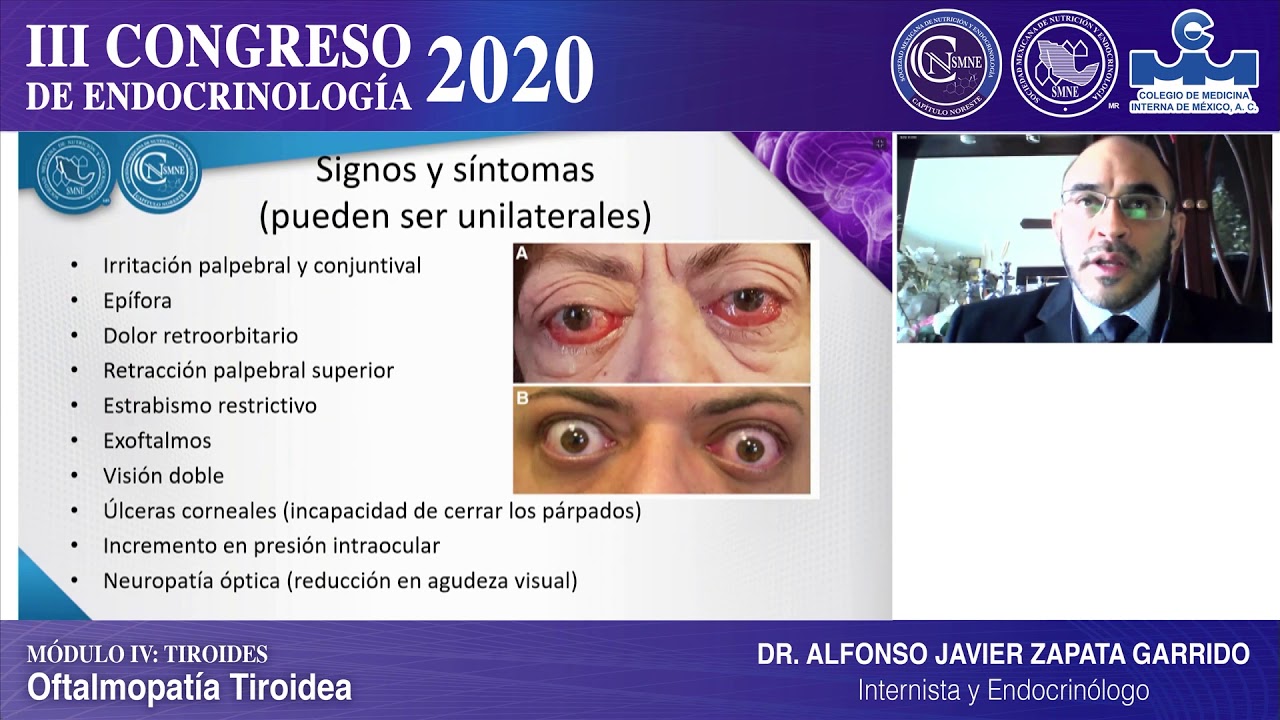 Dr. Alfonso Javier Zapata Garrido, Oftalmopatía Tiroidea.