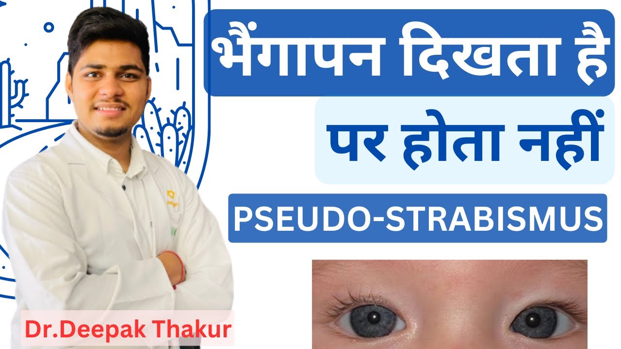 आखें सही होने पर भी भैंगापन आखों में दिखना | What is pseudo strabismus