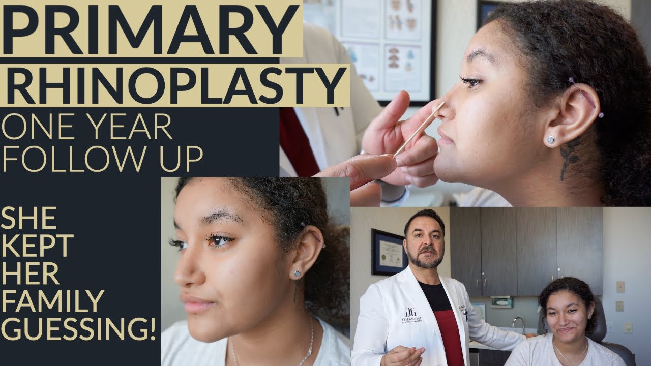 She Kept Her Family Guessing! | Primary Rhinoplasty Before & After One Year Post Op | Dr. Ghavami
