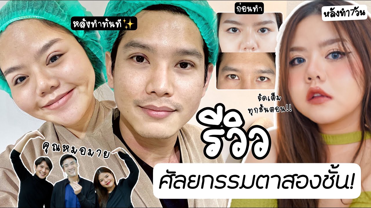 รีวิวแบบจัดเต็ม! ศัลยกรรมตาสองชั้น ตาไม่เท่ากัน ตาหย่อน บวมช้ำน้อยมาก! และอัพเดตหลังครบ 1เดือนเต็ม