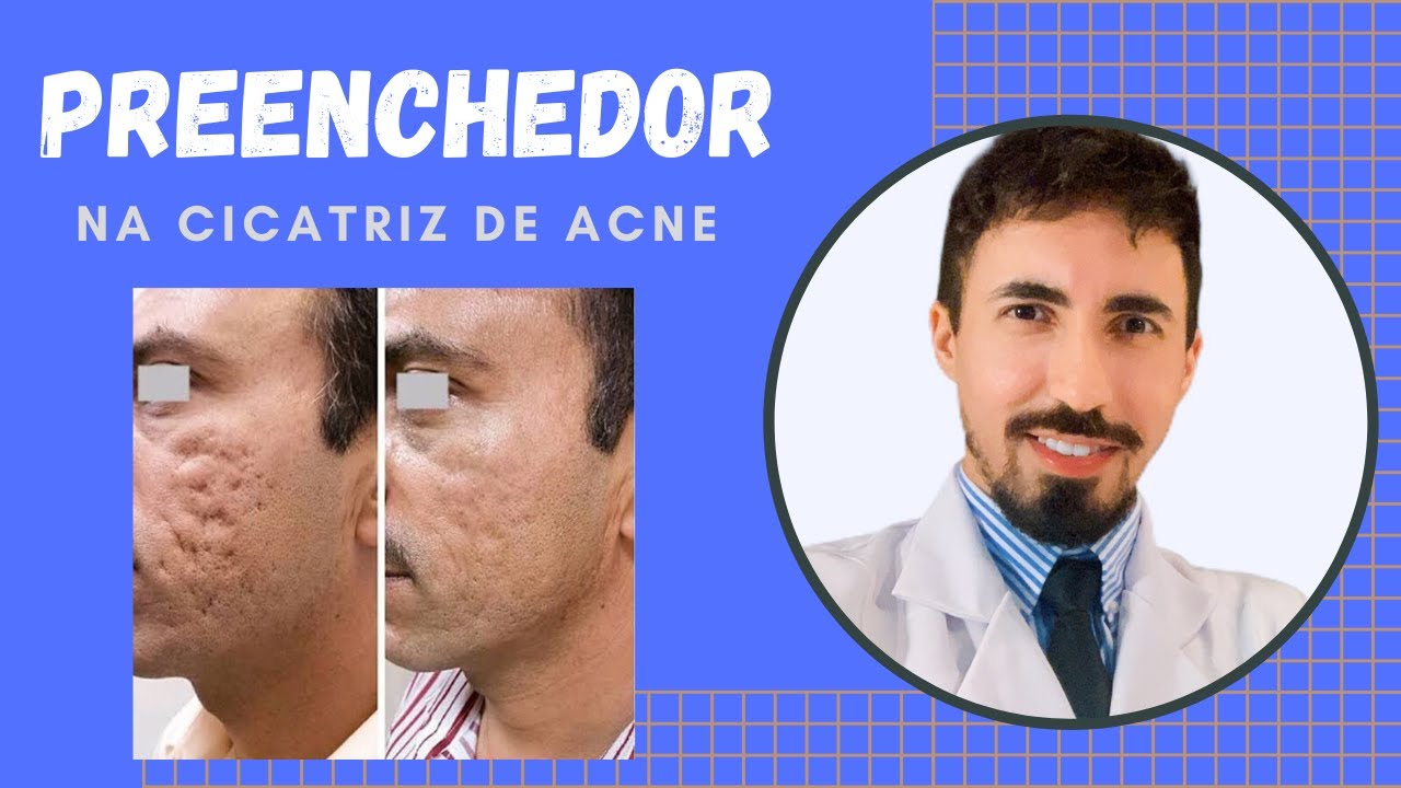 Cicatriz de acne e preenchedores! Mais uma bela arma na recuperação da pele
