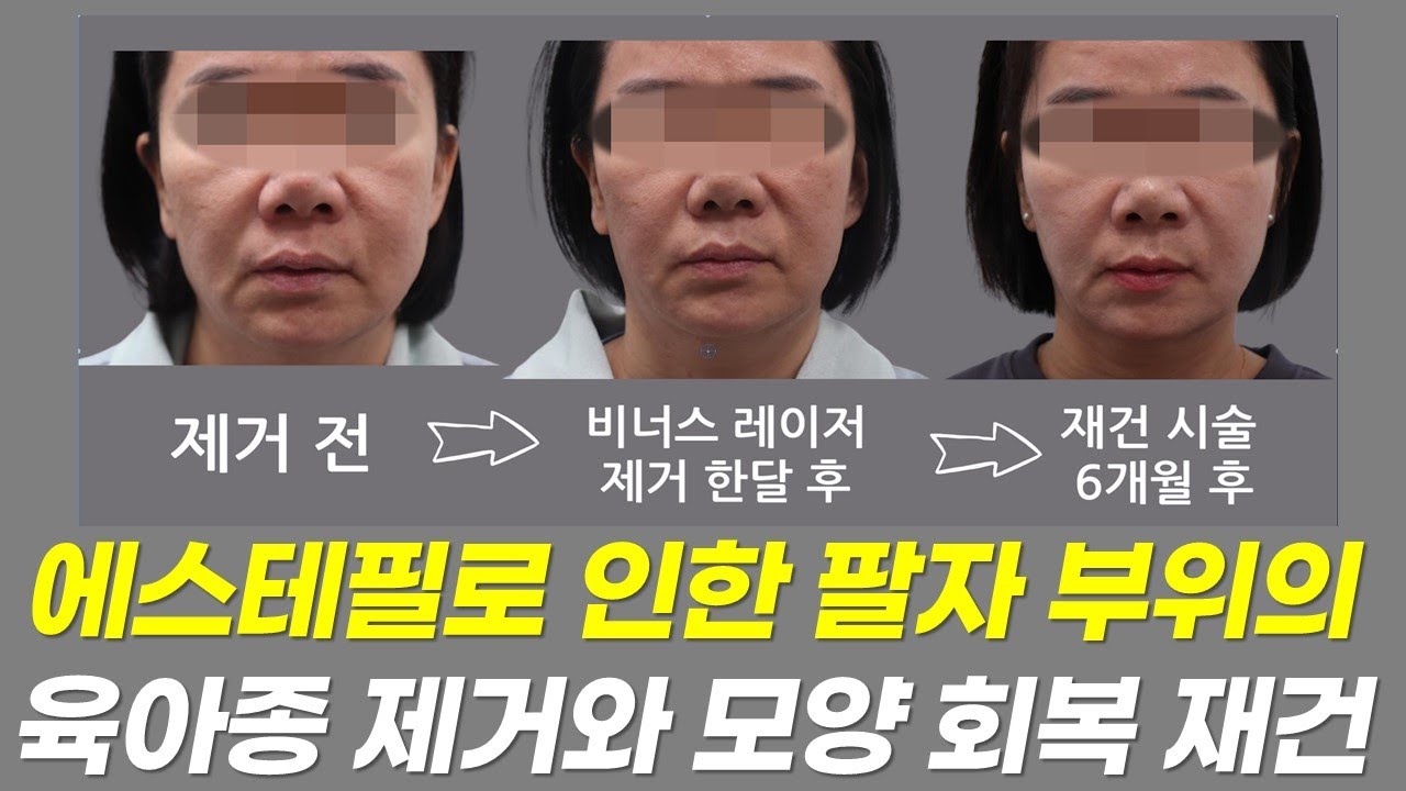 팔자 부위 에스테필 육아종 제거 , 모양 회복 재건