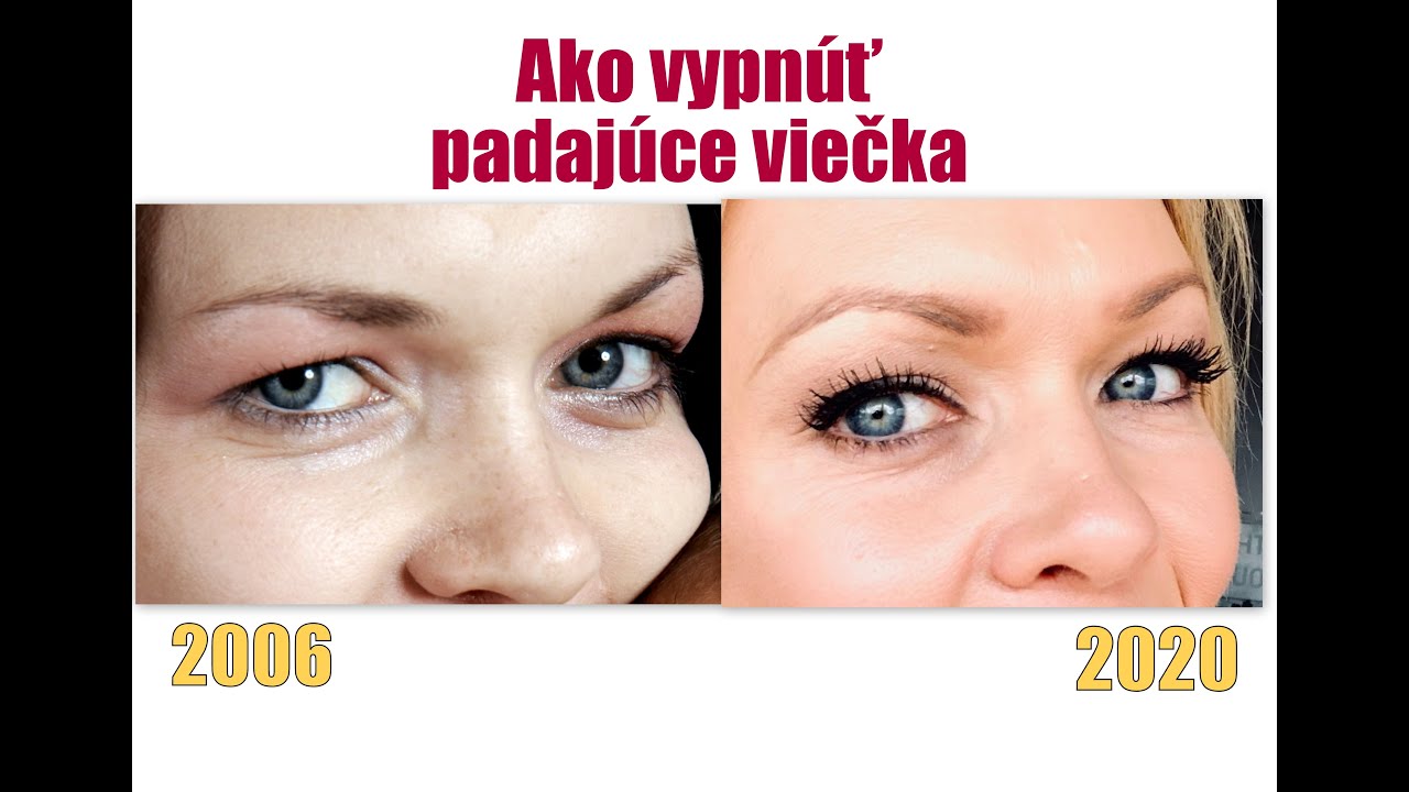 Ako vypnúť padajúce očné viečka