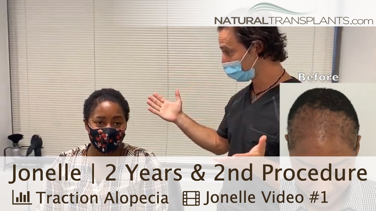 Hair Transplant For Women with Traction Alopecia | Dr. Kevin Blumenthal (Jonelle)