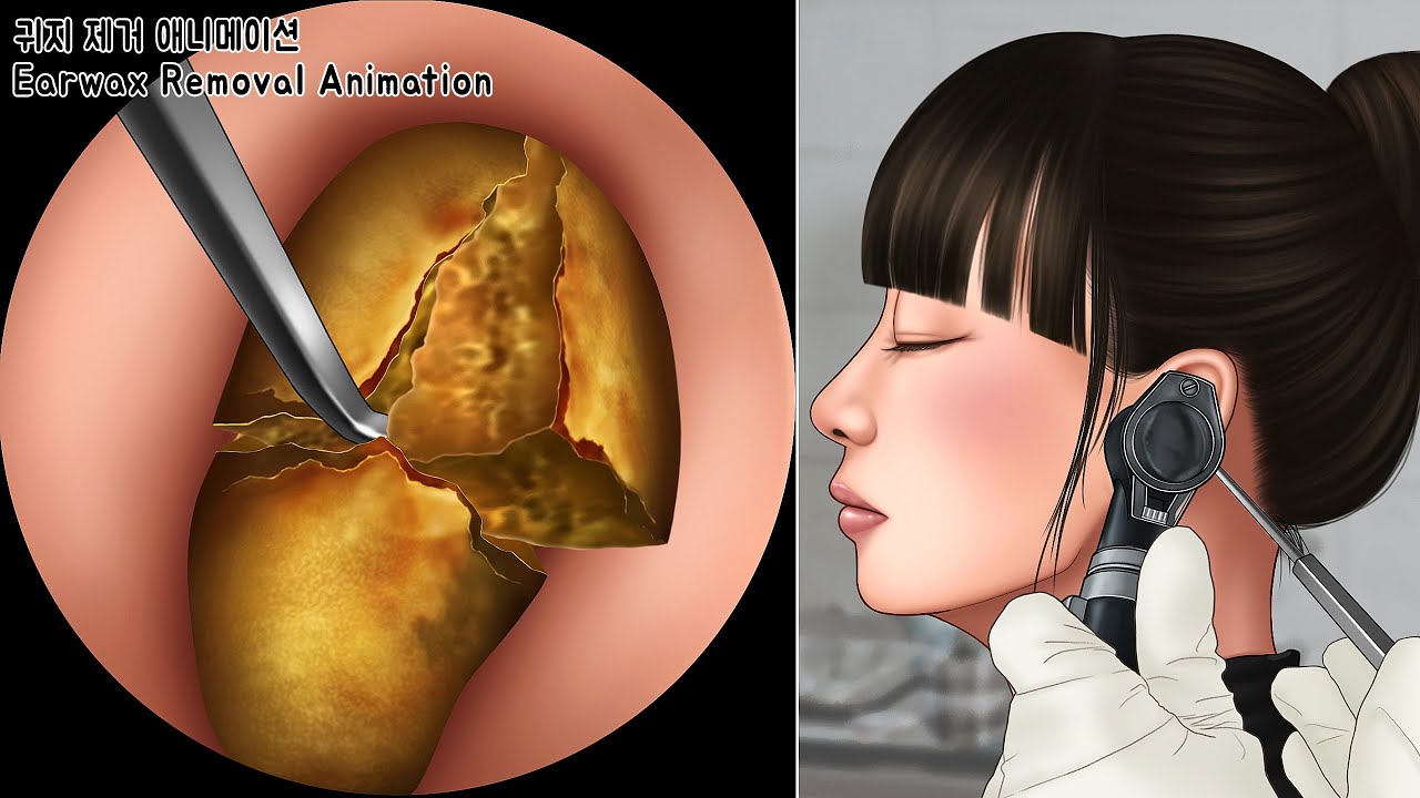 ASMR 시원함 주의! 오랫동안 꽉 막힌 왕귀지 제거하기 | 귀청소 | Deep & Stony Hard Earwax Removal | Ear Cleaning