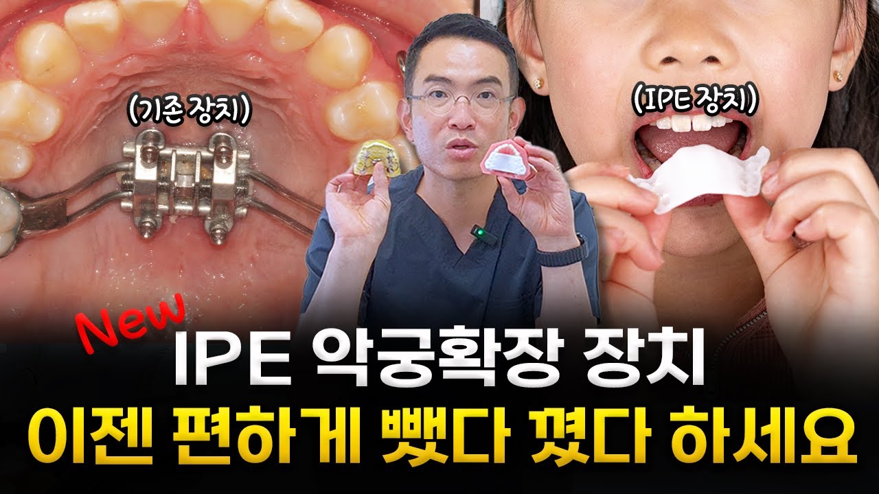 혁신적인 'IPE 악궁확장장치' 편리함의 급이 다르다│치아교정, 소아교정, 인비절라인, 인비절라인 치과, 치아교정 전문의, 교정치과