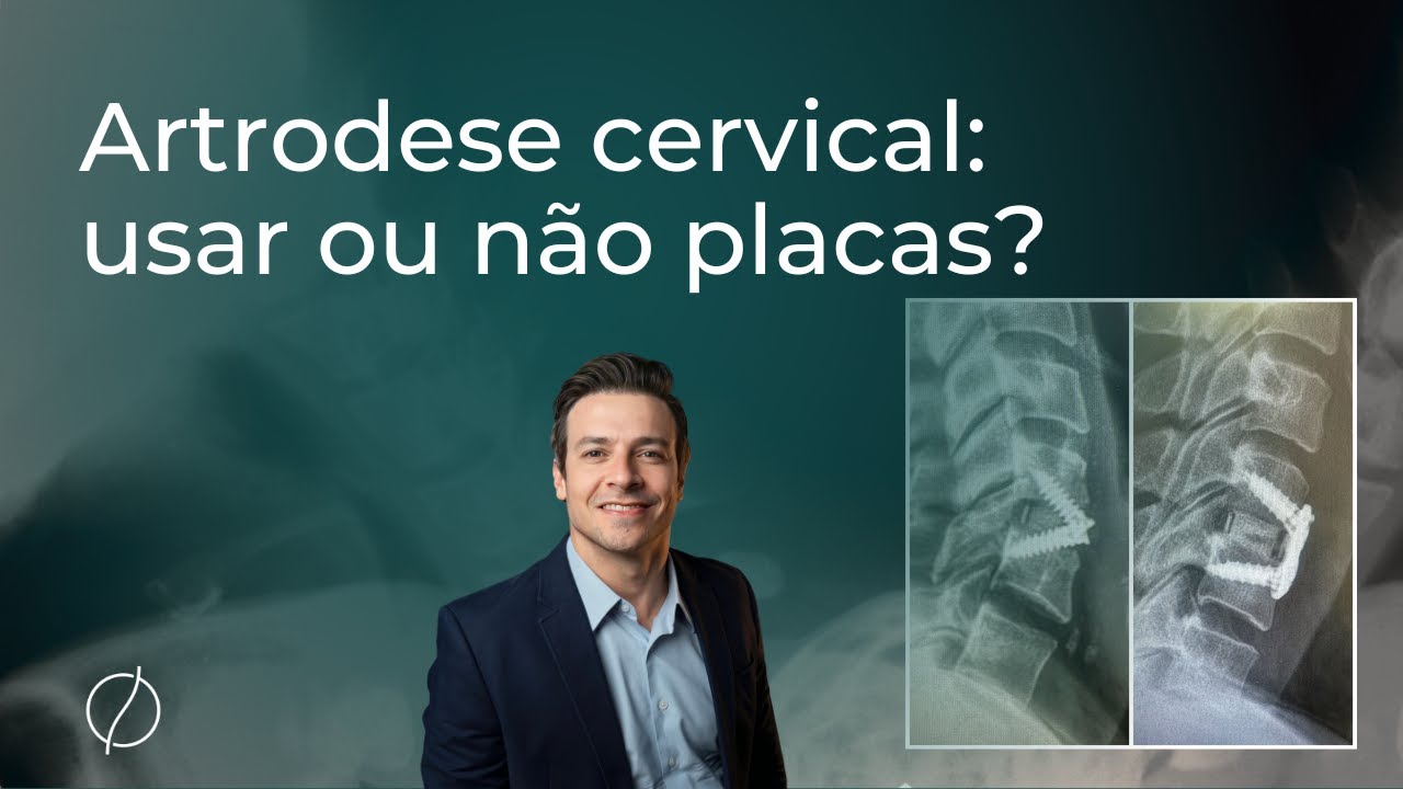 Artrodese cervical anterior: usar ou não placas?