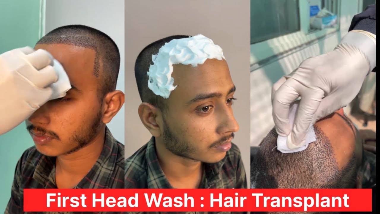 My First Head-wash || Day 07 || Hair Transplant Update
