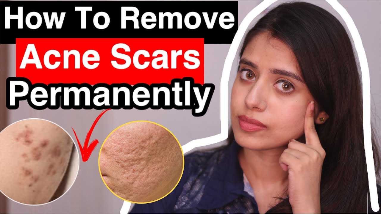 HOW TO REMOVE ACNE SCARS PERMANENTLY | Treatment for hyper pigmentation, dark spots in Tamil