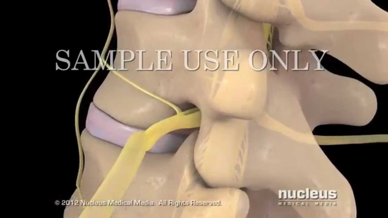 Lesiones de disco lumbar y tratamiento