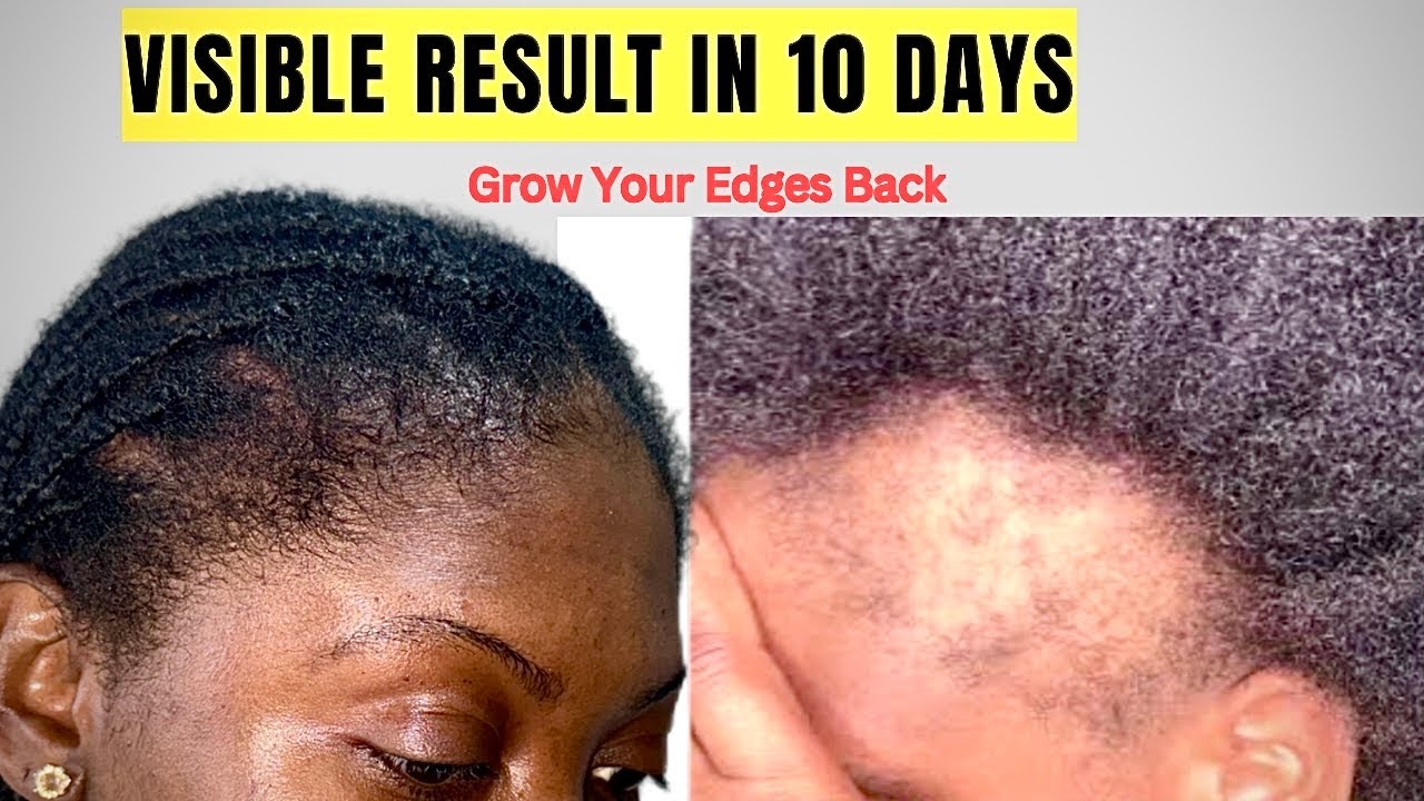 This Ayurvedic Herbs will grow your edges like GRASS/I used this simple method to regrow my hairline