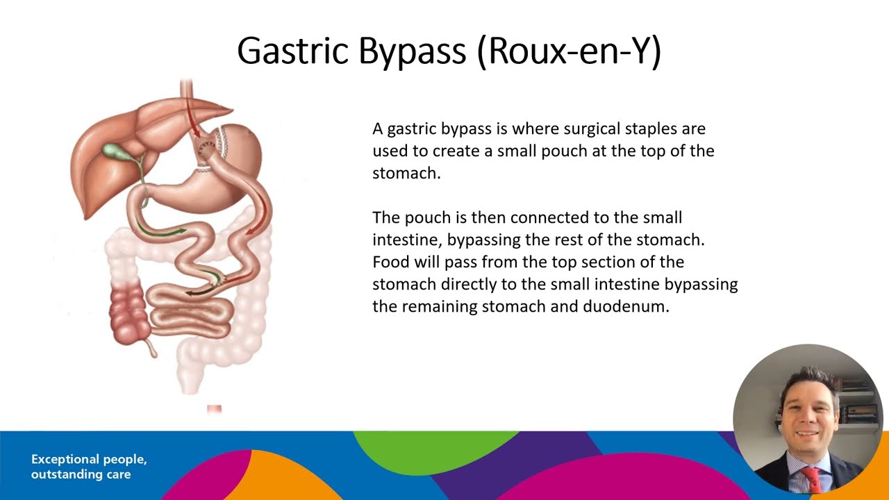 Bariatric surgery types