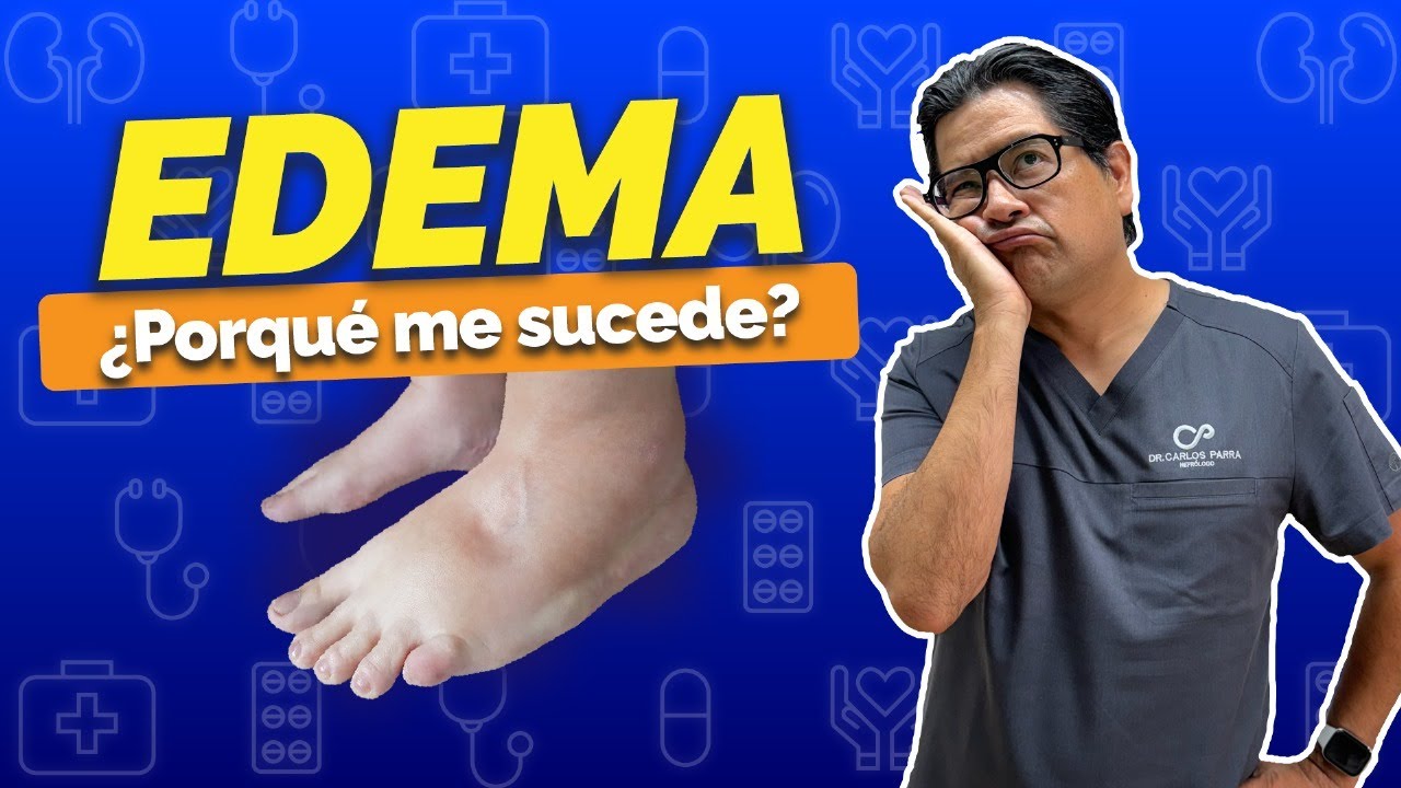 EDEMA ¡¿Porqué me sucede?!