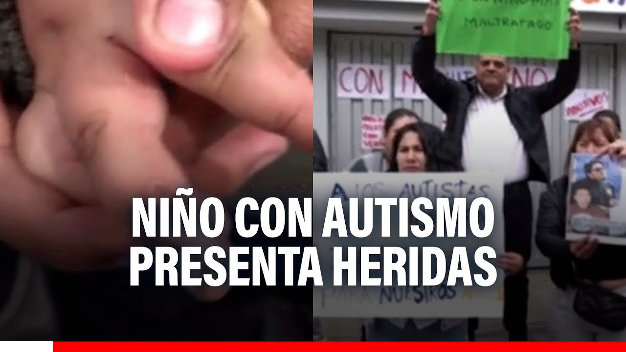 🔴🔵¡Indignante! Niño con autismo presenta heridas en las manos tras maltrato en centro de terapia