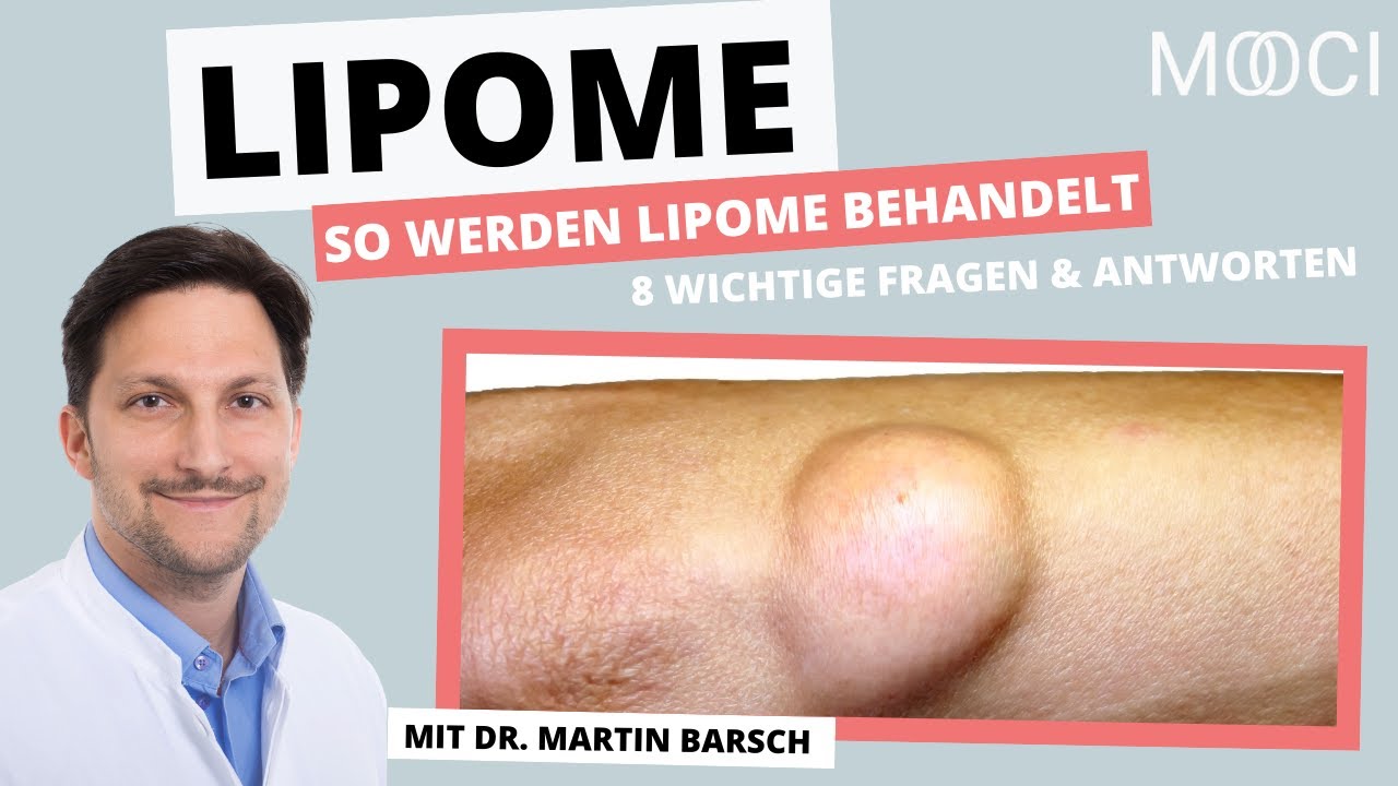 Wie kann ich Lipom behandeln? 8 wichtige Infos