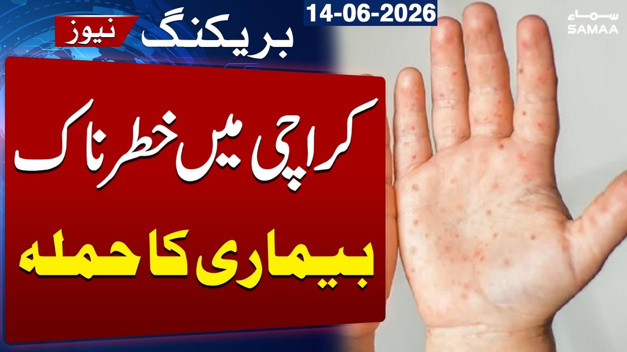 Karachi Faces Outbreak of Dangerous Disease | Breaking News | SAMAA TV