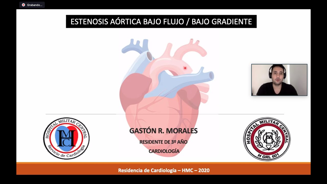 Estenosis aortica bajo gasto bajo flujo   módulo valvulopatías