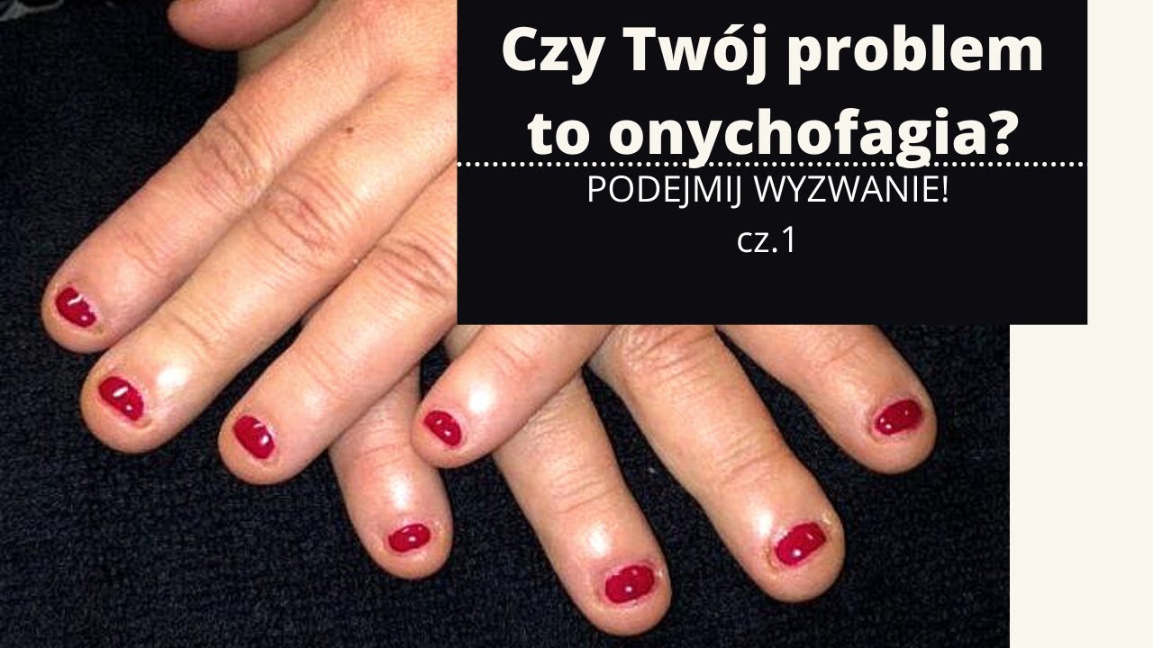 Onychofagia, obgryzanie paznokci. Podejmij wyzwanie, zmień wygląd swoich paznokci. #1