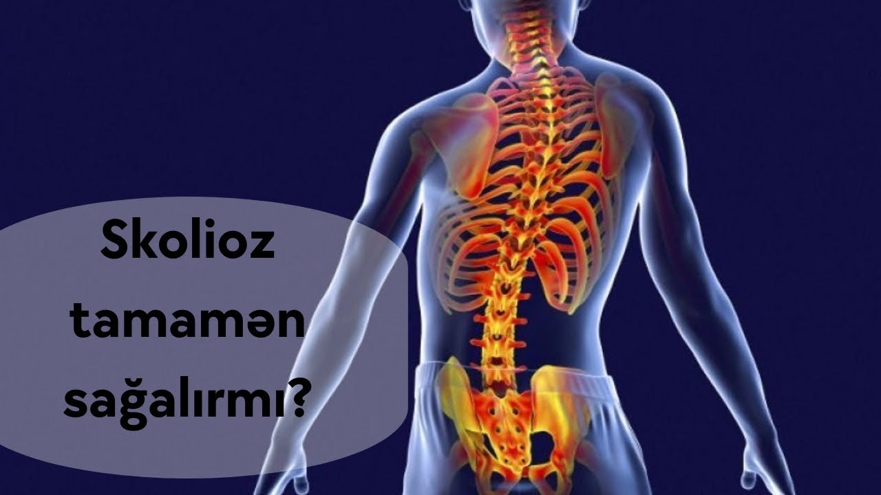 SKOLİOZ TAMAMƏN SAĞALIRMI? | FİZİOTERAPEVT AZİZ DAVRİSHOV