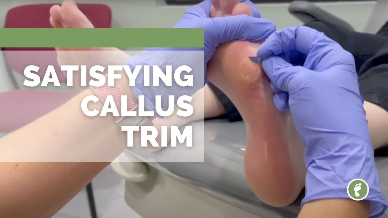 SATISFYING CALLUS TRIM 🔪