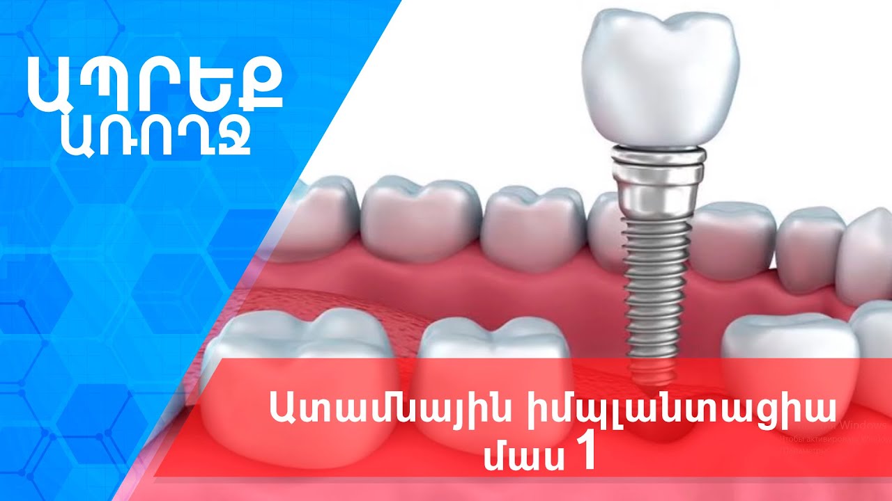 Ապրեք առողջ I Ատամնային իմպլանտացիա, մաս 1
