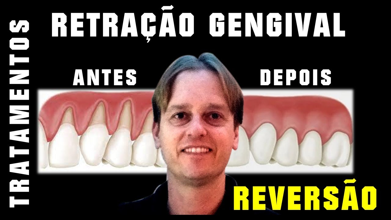 Retração Gengival -Tratamentos e Reversão Antes e Depois - Cirurgia Plástica de Gengiva ou Resina.