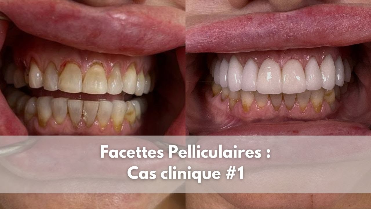 Facettes pelliculaires - Cas clinique #1