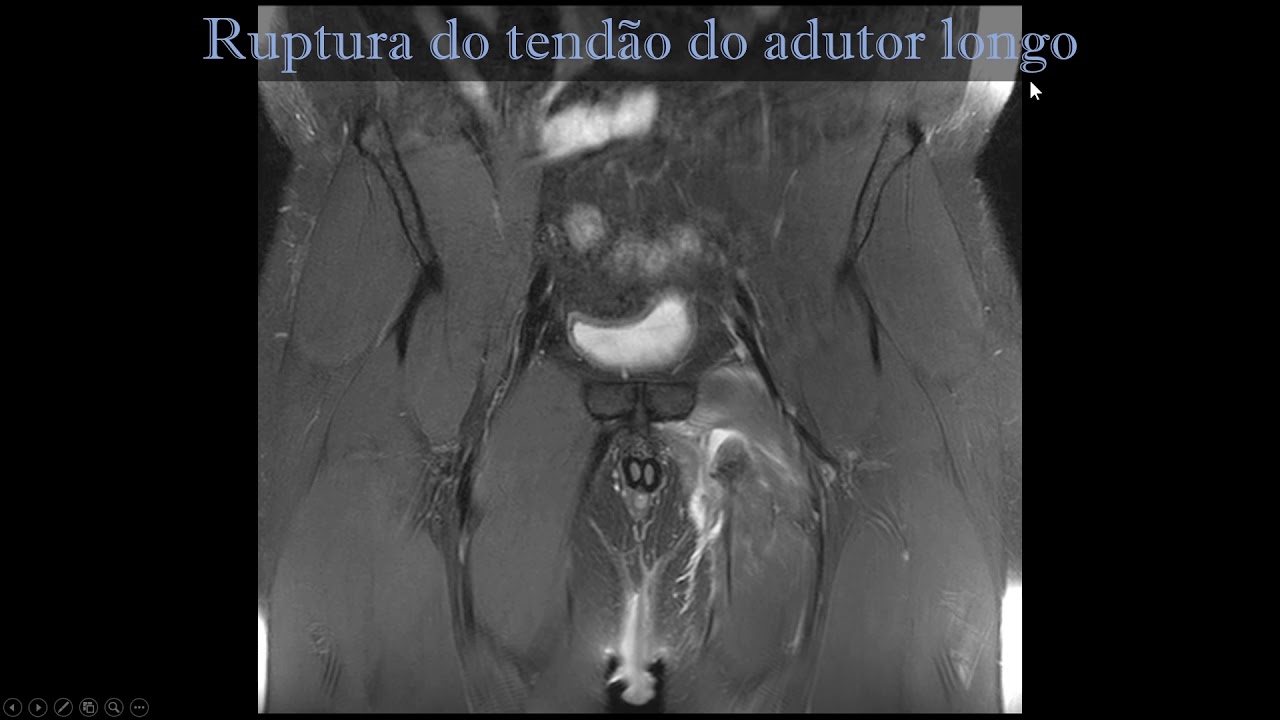 Ruptura do tendão adutor longo