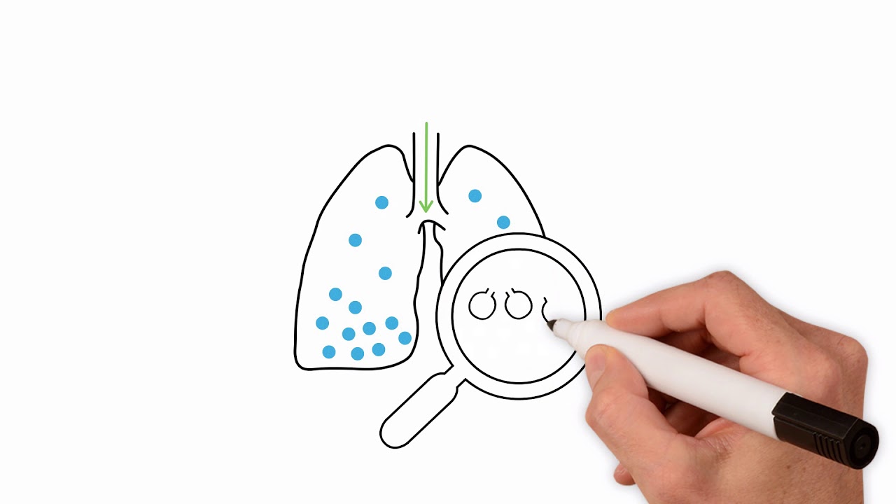 Mastering the Nitrogen Washout Test: Small Airways Assessment Explained