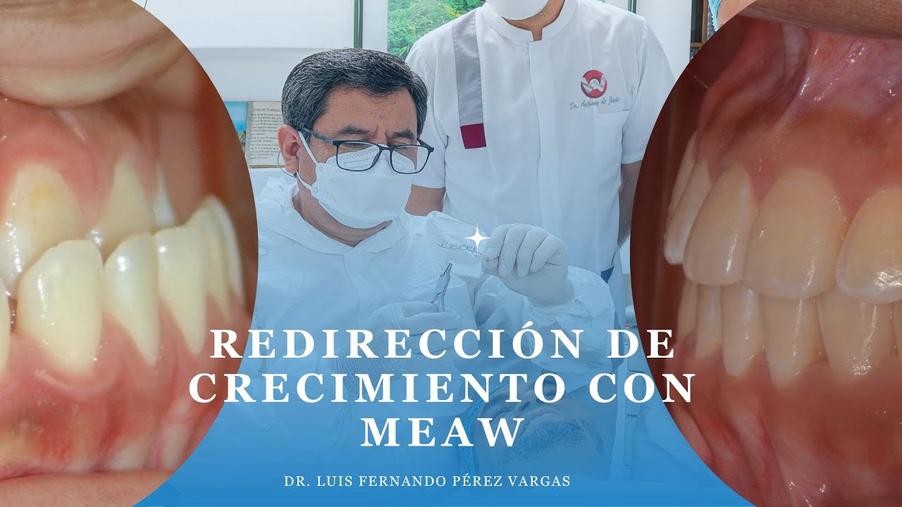 Redirección de crecimiento con MEAW