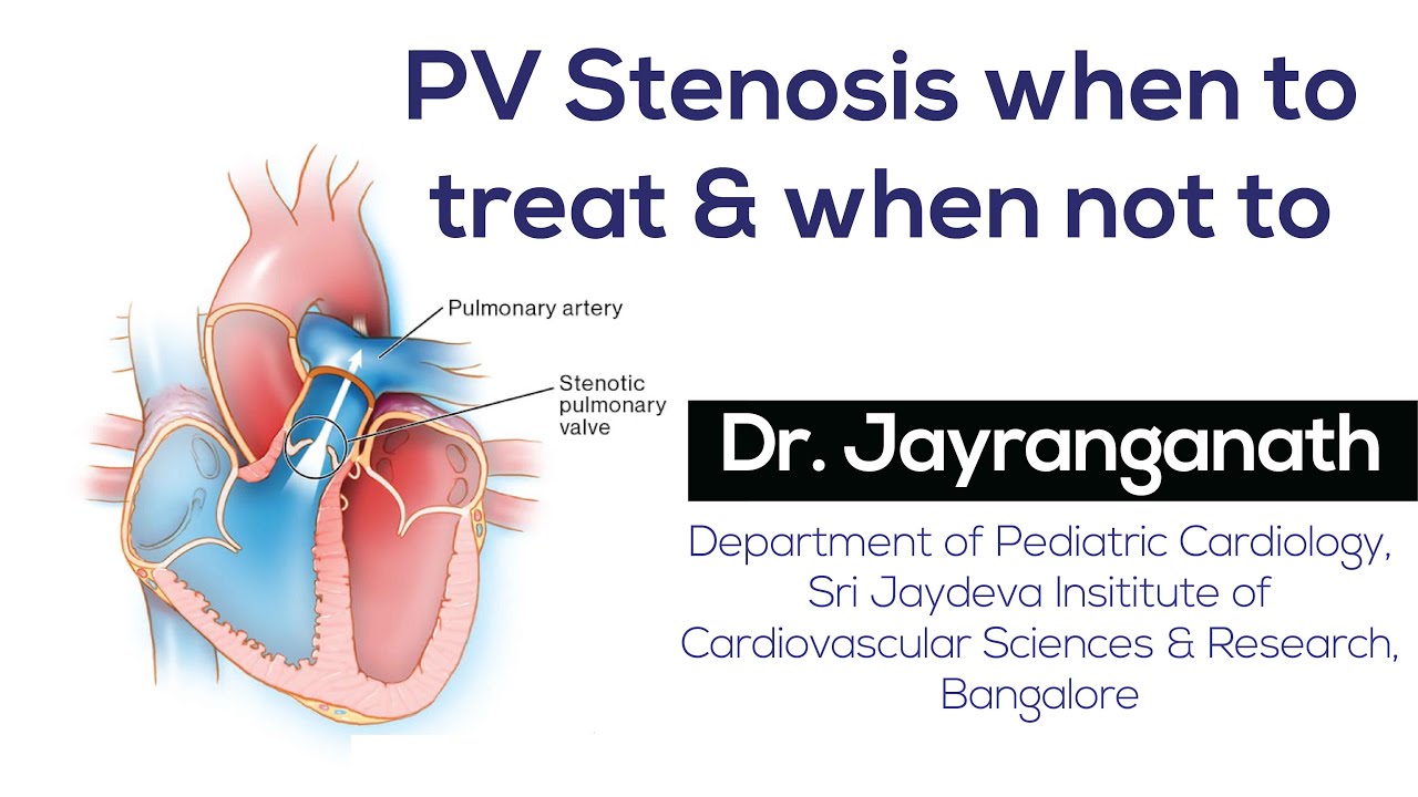 PV Stenosis when to treat & when not to