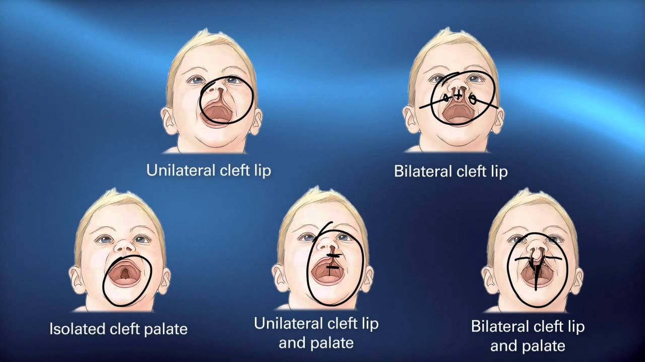 Cleft Diagnosis - Pediatric Playbook - Boston Children's Hospital