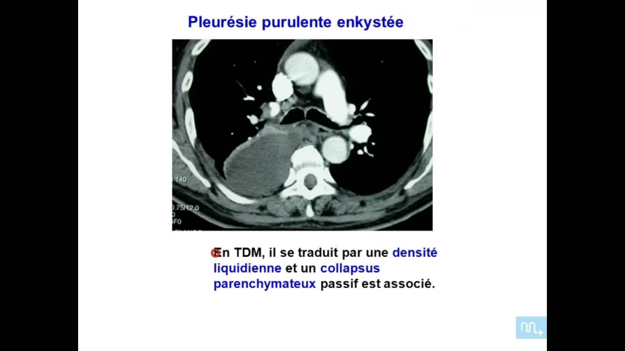 Les Grandes syndromes pulmonaires   Partie 2
