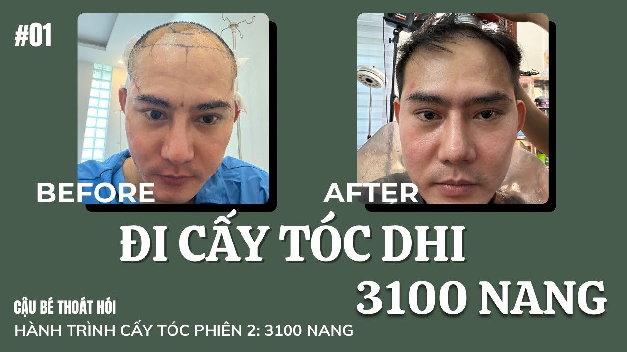 CHUẨN BỊ CẤY TÓC DHI TRỊ HÓI PHIÊN 2 VỚI 3100 NANG #01 l Hành Trình Cấy Tóc PHIÊN 2