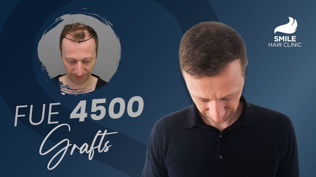 Before & After Hair Transplant: 3, 6, 9 Month Growth Update 4500 Grafts