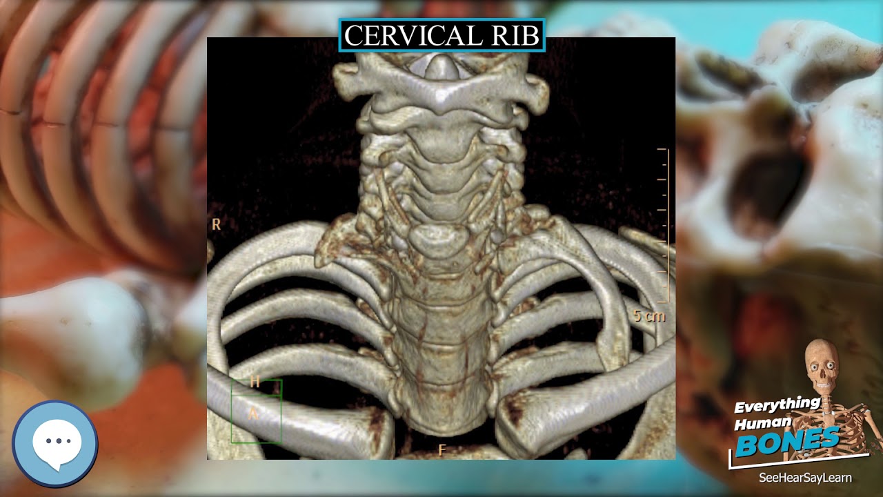 Cervical rib 🦴 Everything Human Anatomy Bones 🦴