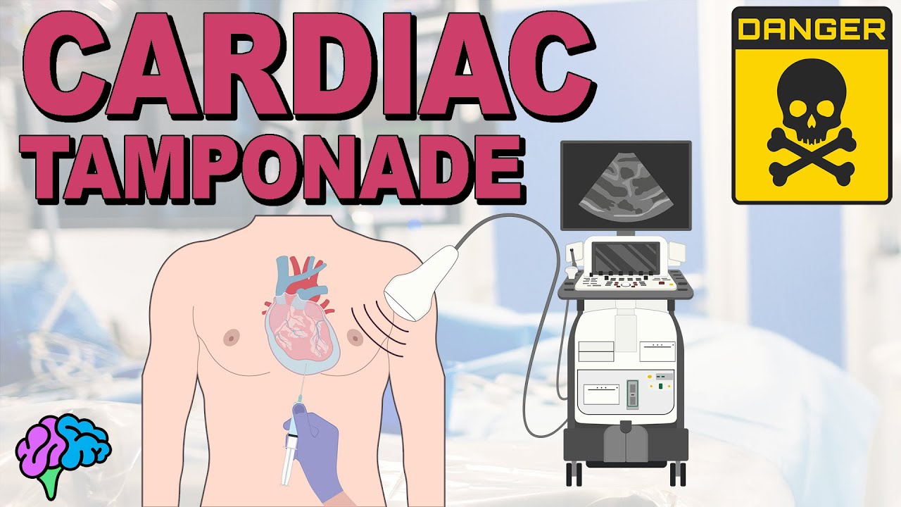 Cardiac Tamponade Made Simple