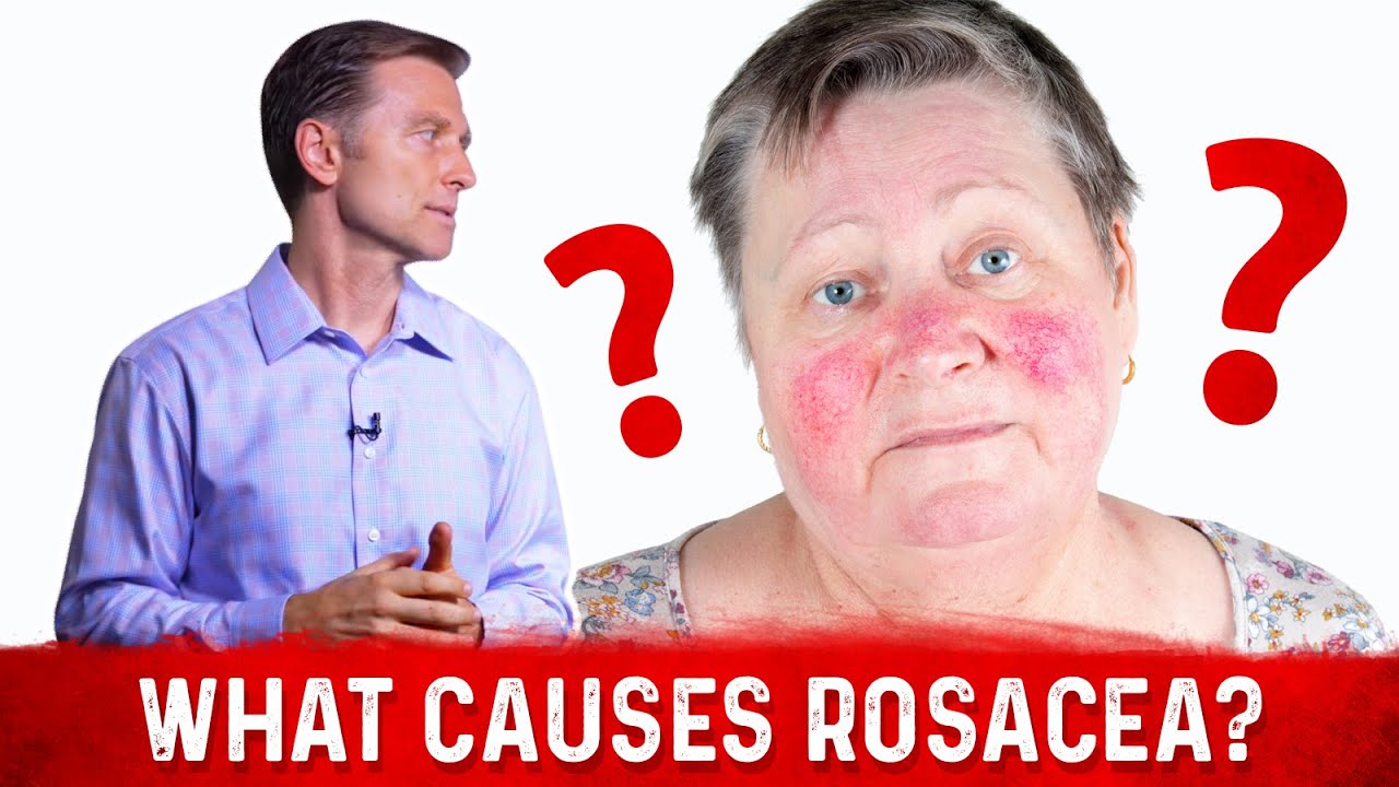 Dr. Berg&rsquo;s Opinion on Causes of Rosacea and Its Treatment