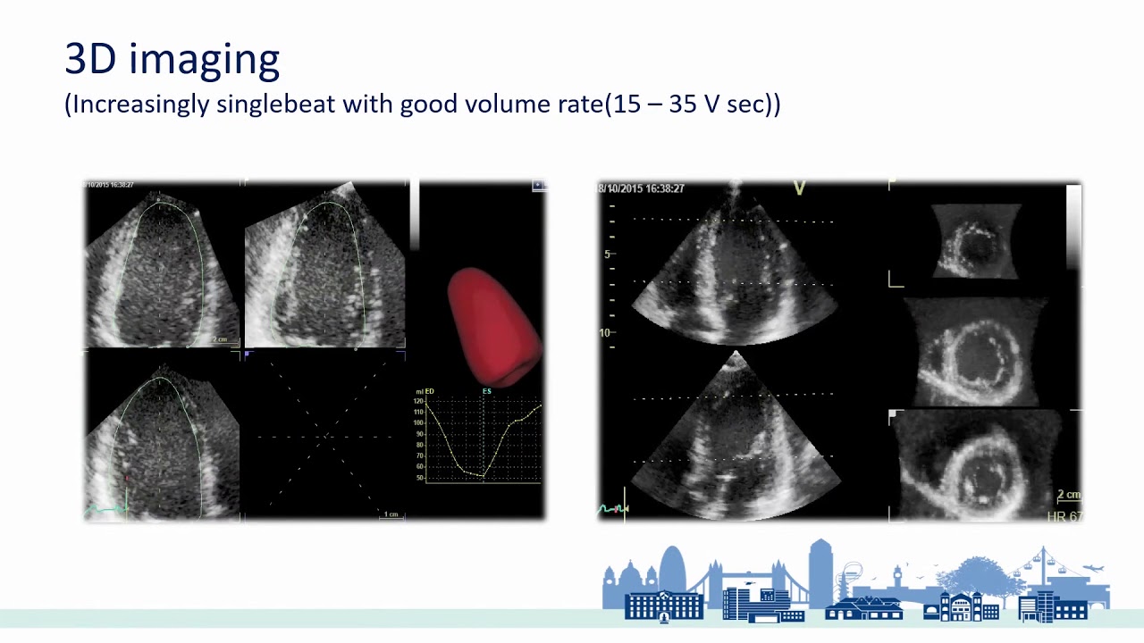 Advanced Echocardiography - GLS Strain Imaging,2D to 4D and other Advanced Echo Knowledge