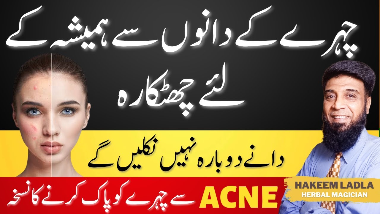 Acne Treatment at Home | Chehry k Dano ka Fori ilaj | Face Acne ka ilaj | Dany Hamesha k liye khatam