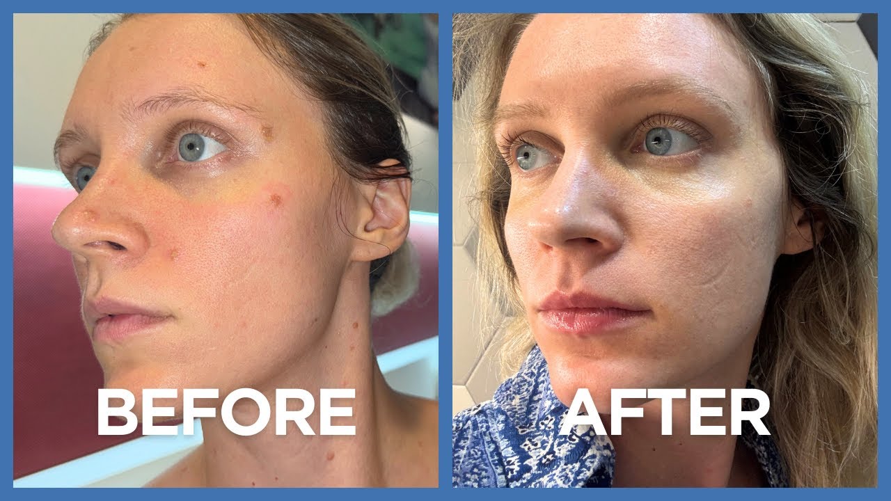 Удаление 16 родинок в Южной Корее!!